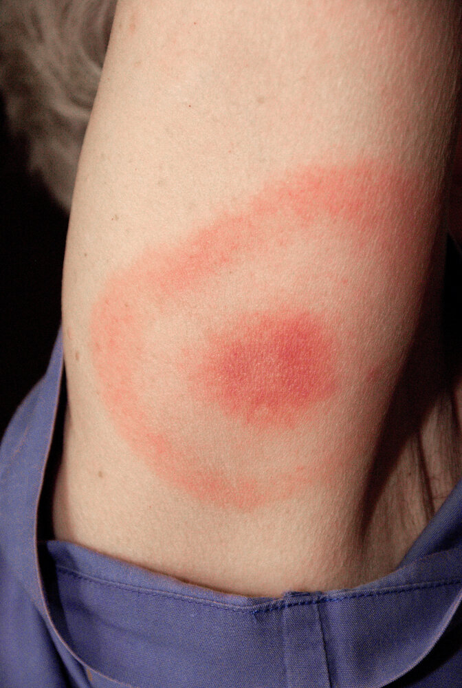 Erythema migrans in stage-I Lyme disease