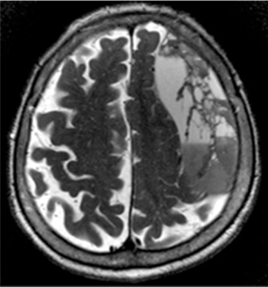 Subacute on chronic subdural hematoma