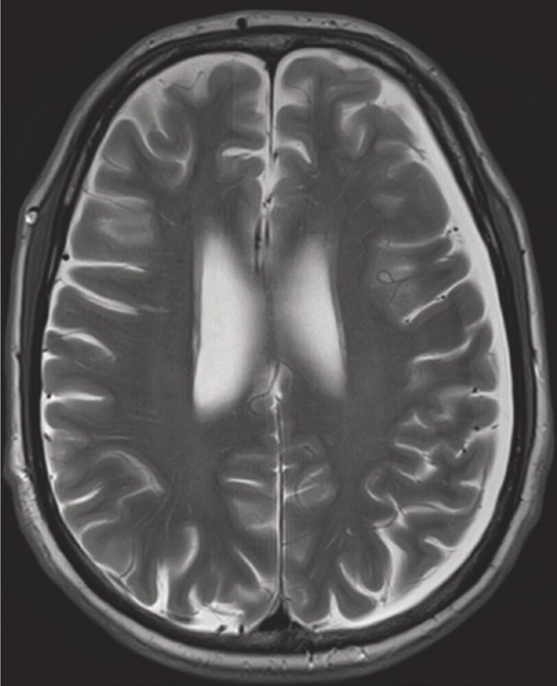Chronic subdural hematoma
