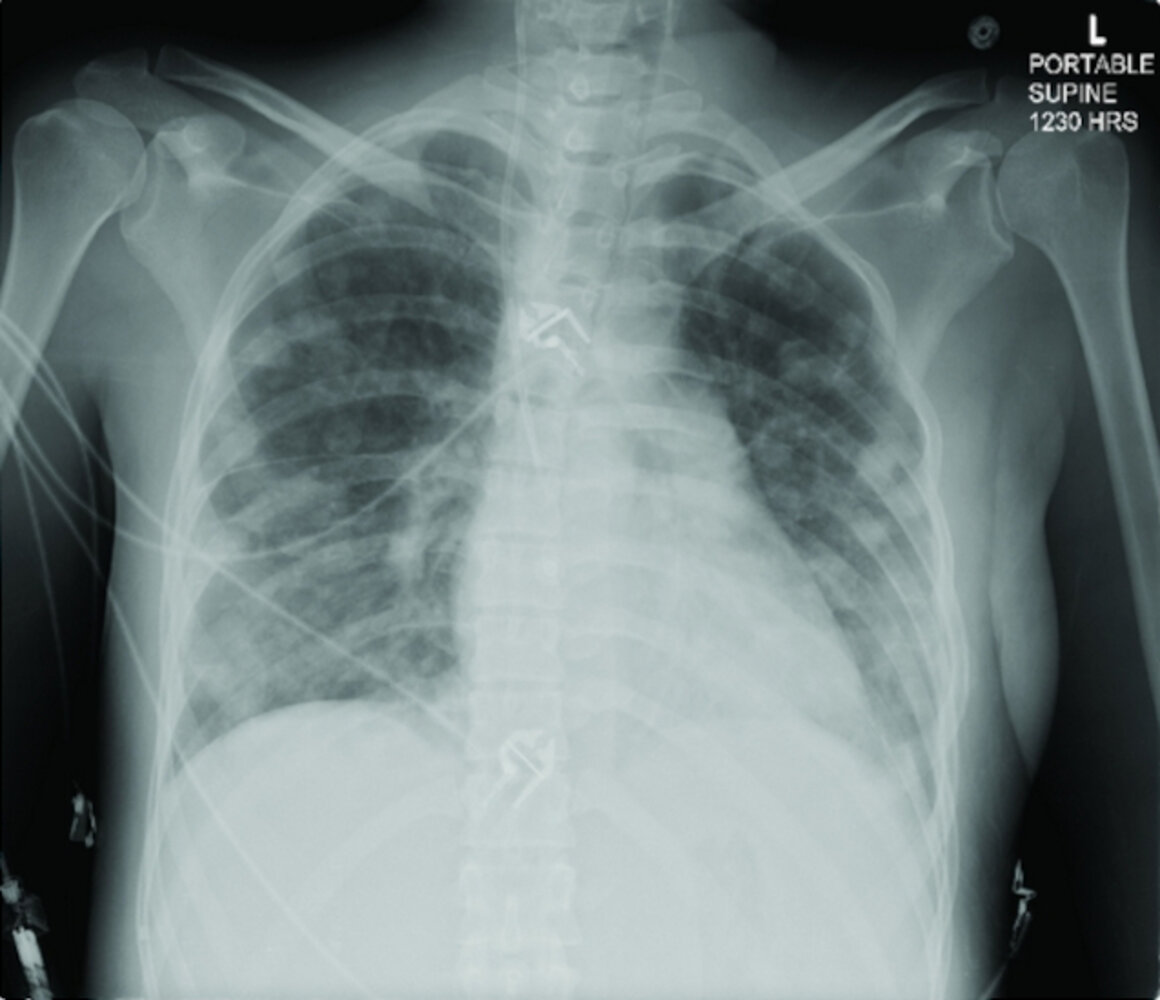 Septic pulmonary emboli