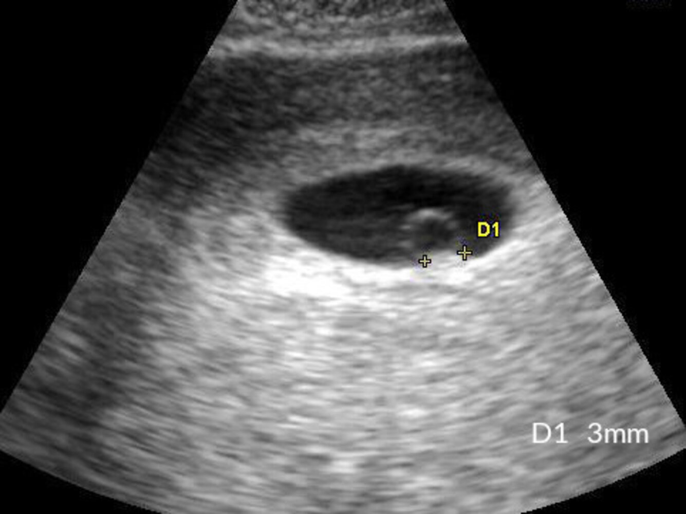 First trimester ultrasound, double sac sign