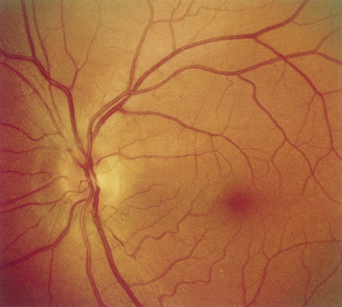 Papillitis in optic neuritis