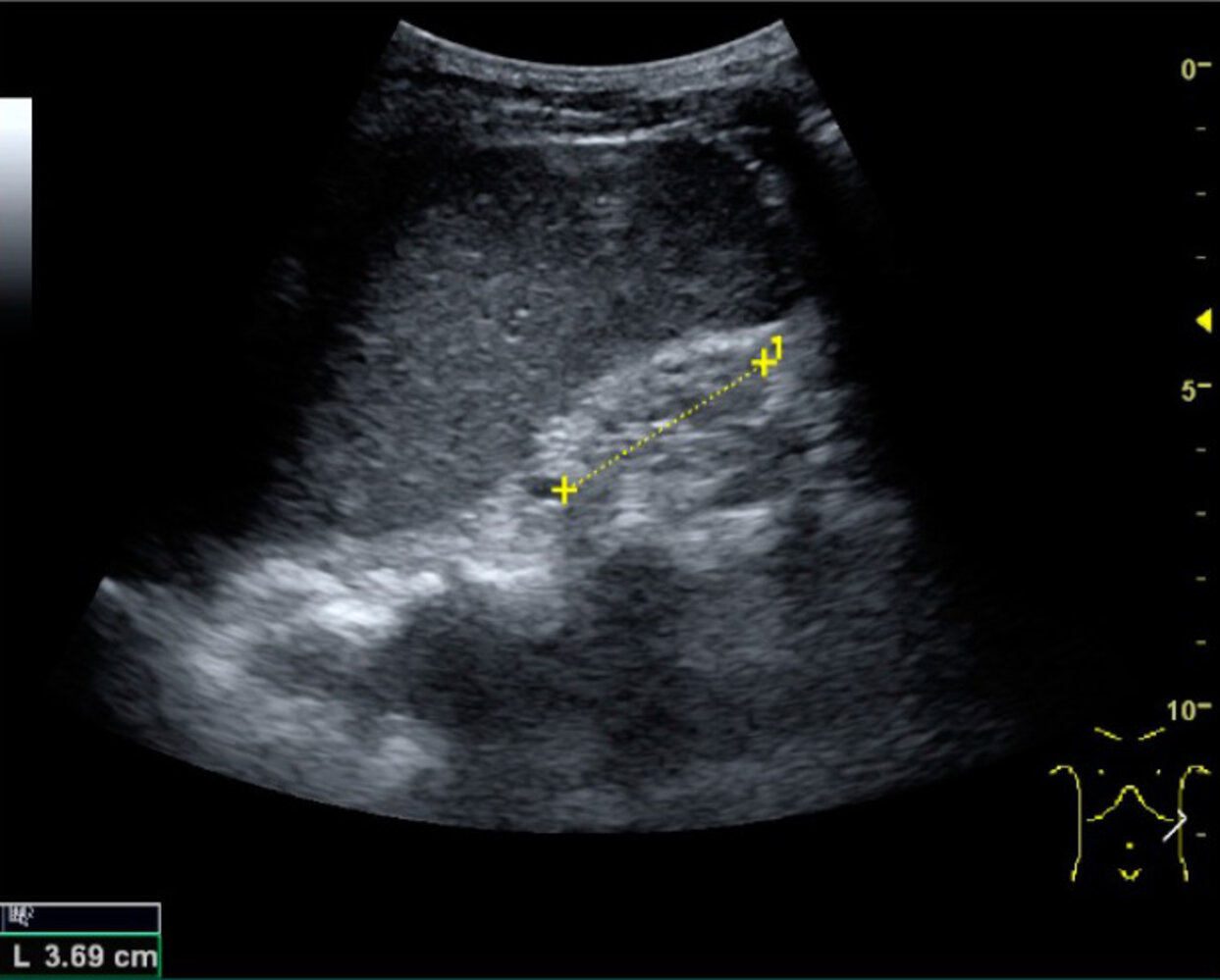Ultrasound in chronic renal disease