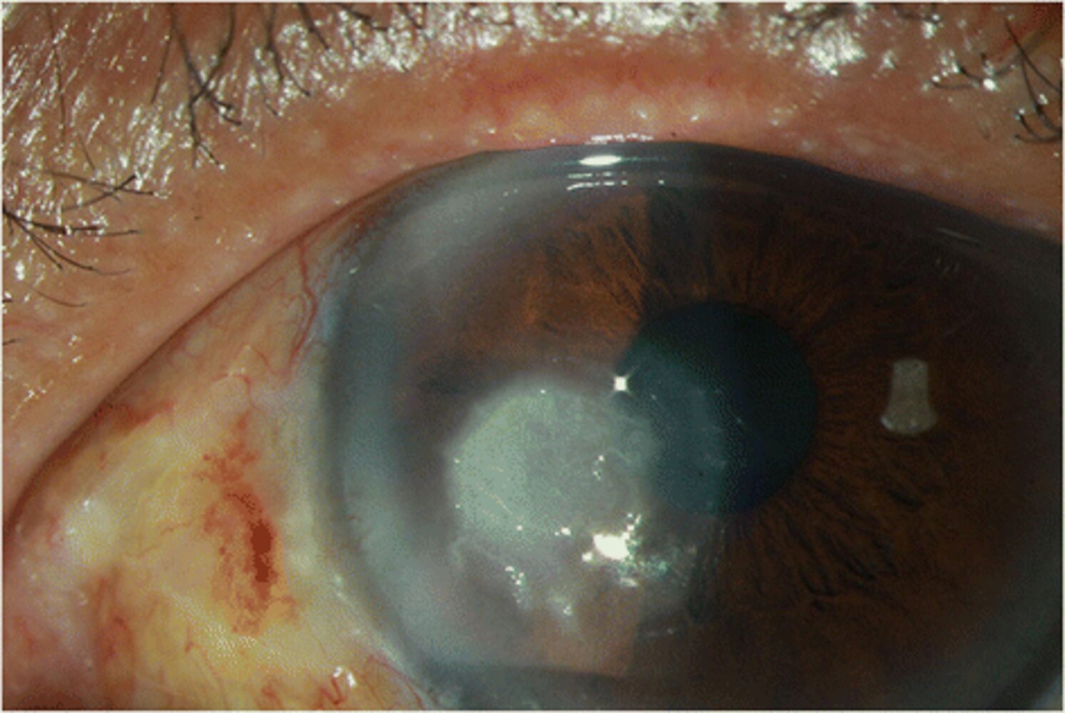 Mycotic keratitis