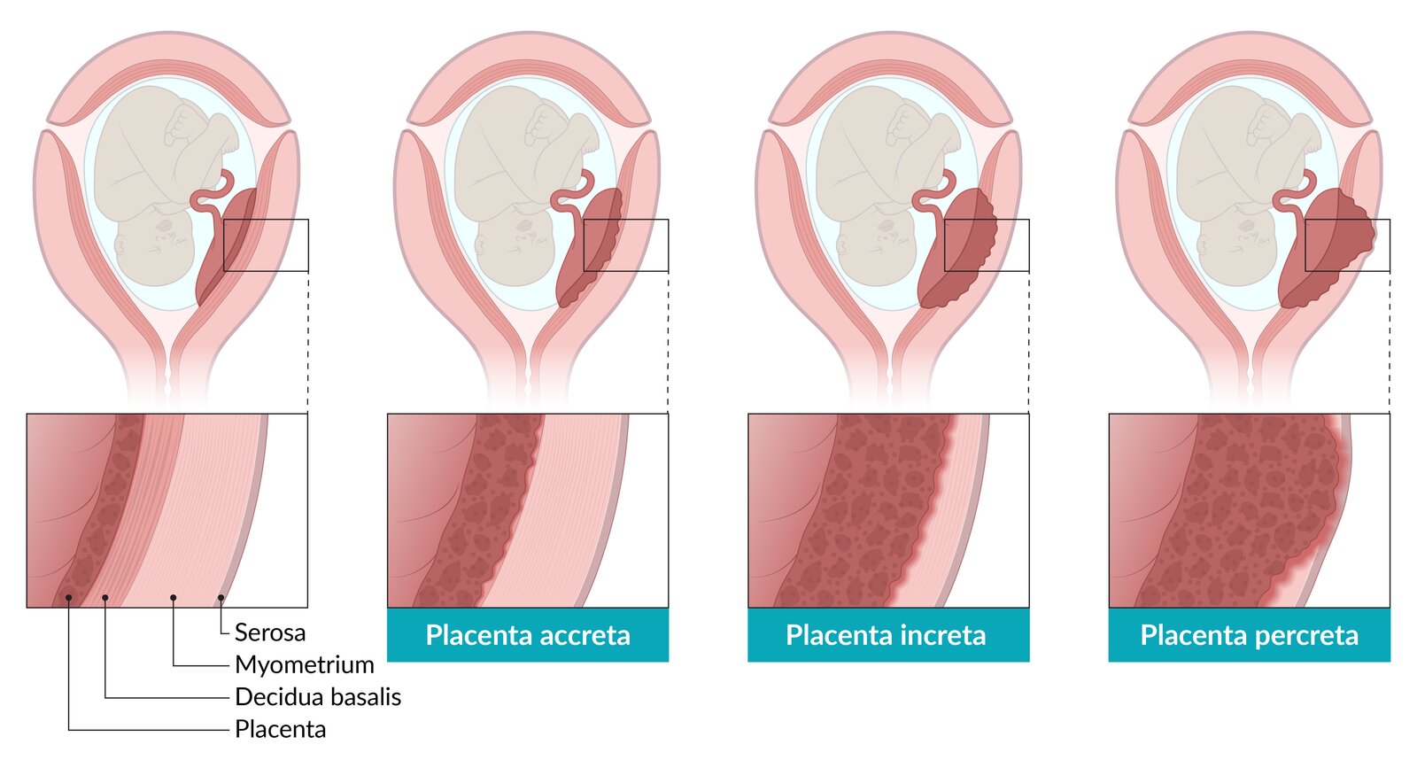 Placental attachment disorders