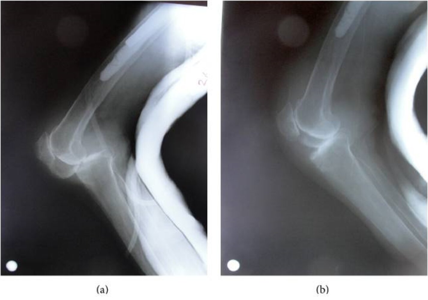 Posterior knee dislocation