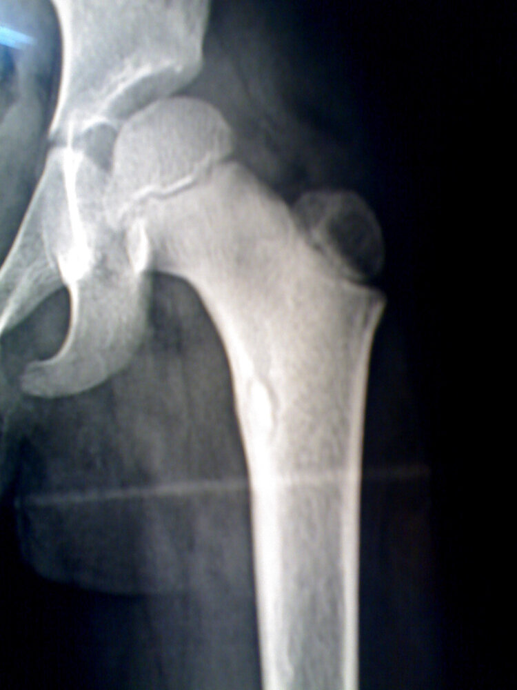 Bony sequestrum