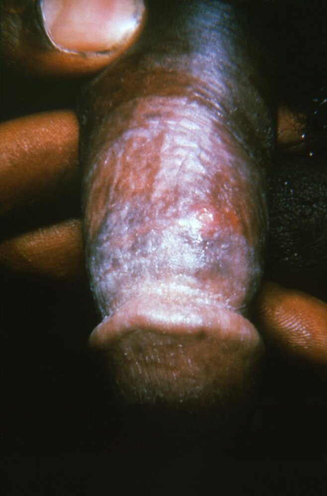 Lymphogranuloma venereum (LGV)