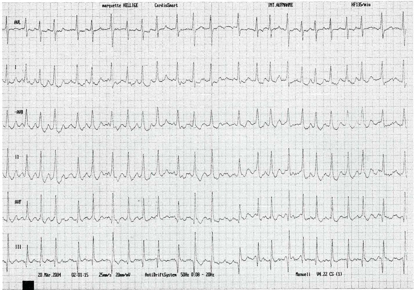 Atrial fibrillation with rapid ventricular response