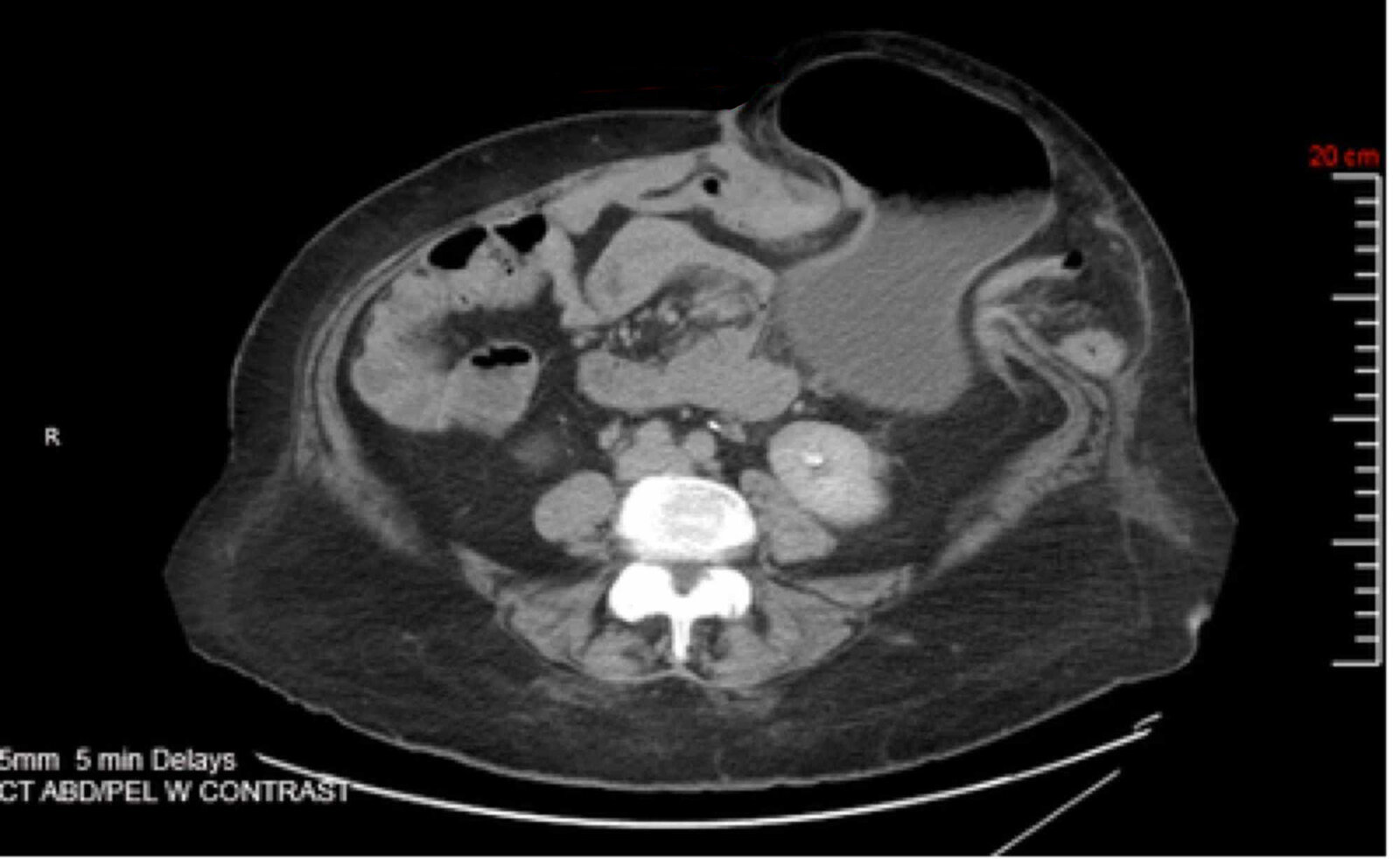 Parastomal hernia