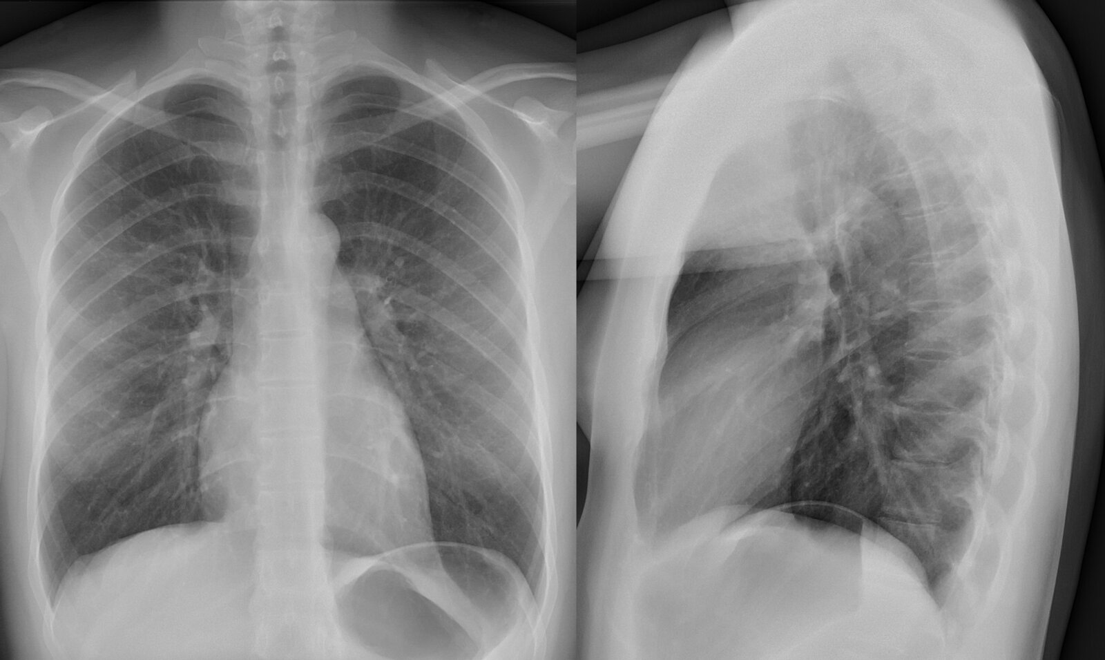 Normal chest radiograph (PA and lateral)