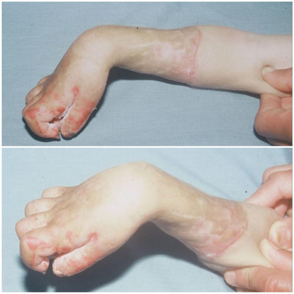 Volkmann ischemic contracture