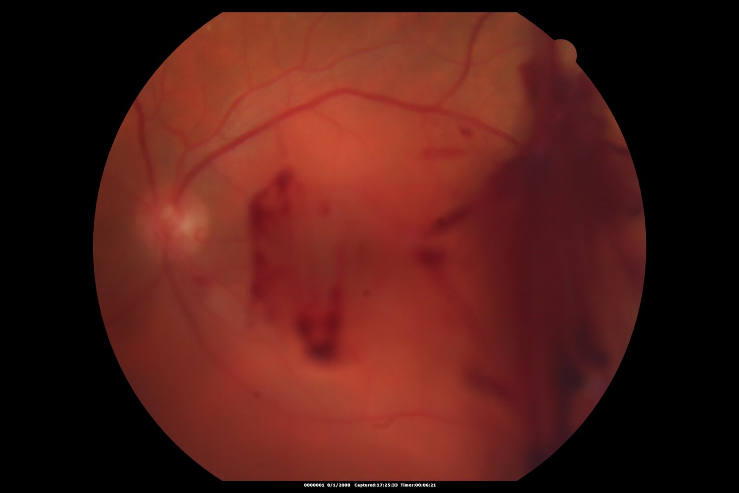 Vitreous hemorrhage