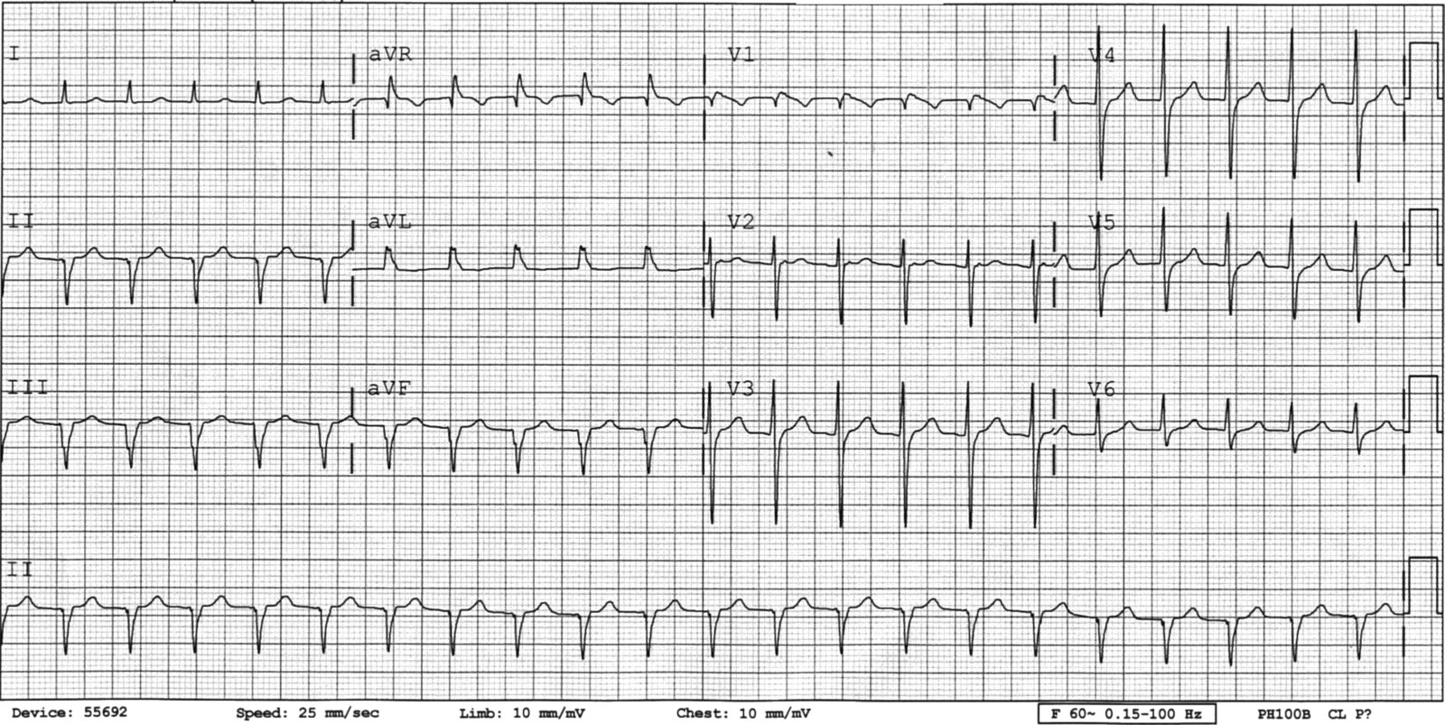 Atrioventricular nodal reentrant tachycardia (AVNRT)