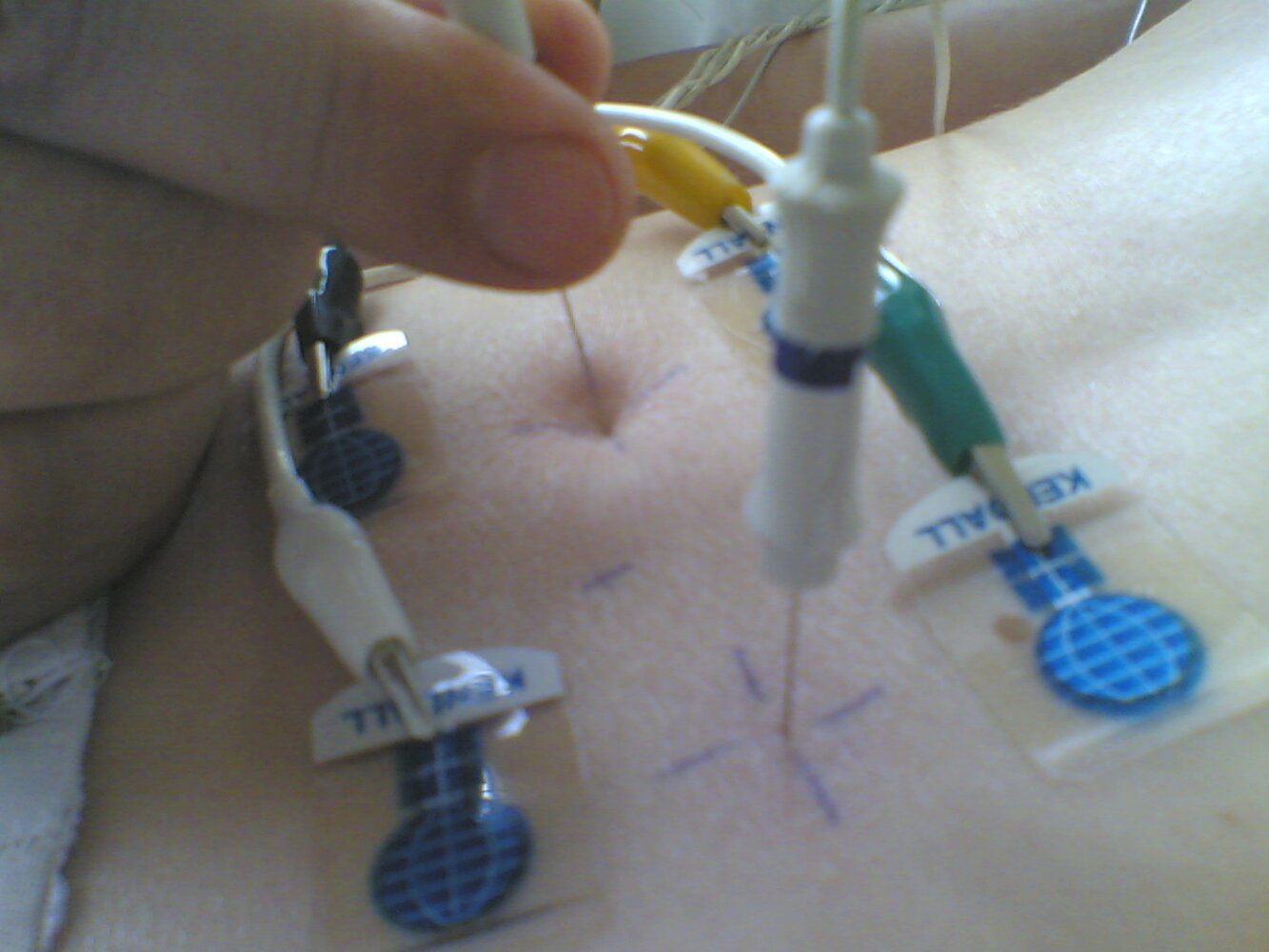 Needle (intramuscular) electromyography (EMG)