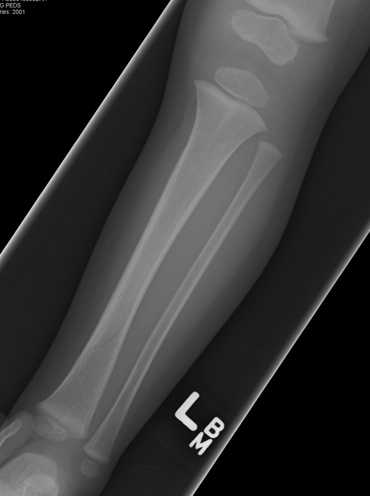 Toddler fracture