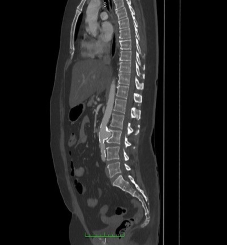 Lumbar spine erosion from abdominal aortic aneurysm