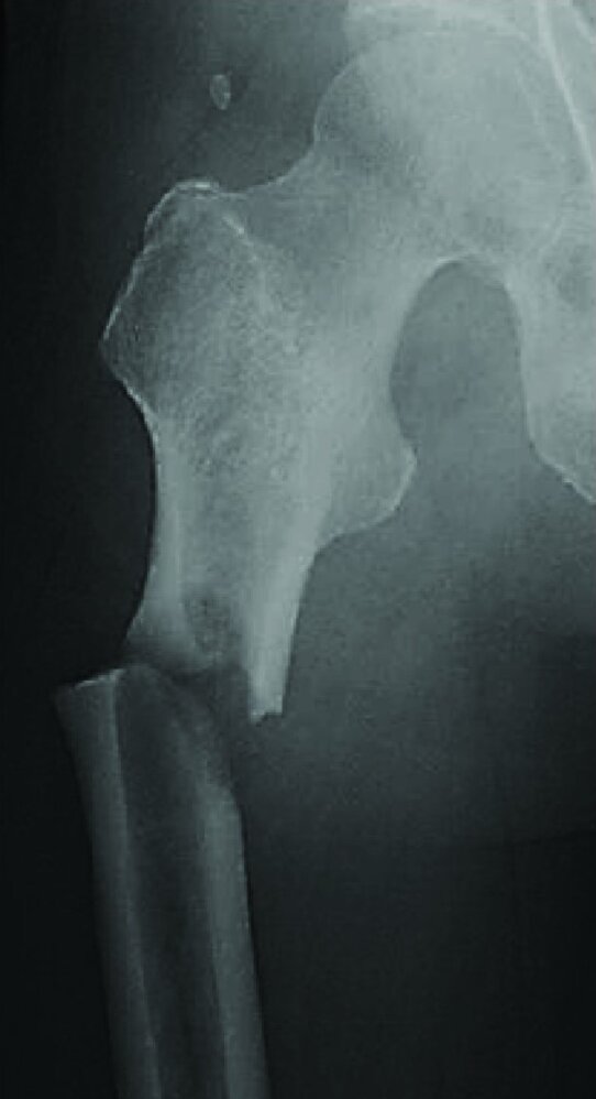 Bisphosphonate-related atypical femoral fracture
