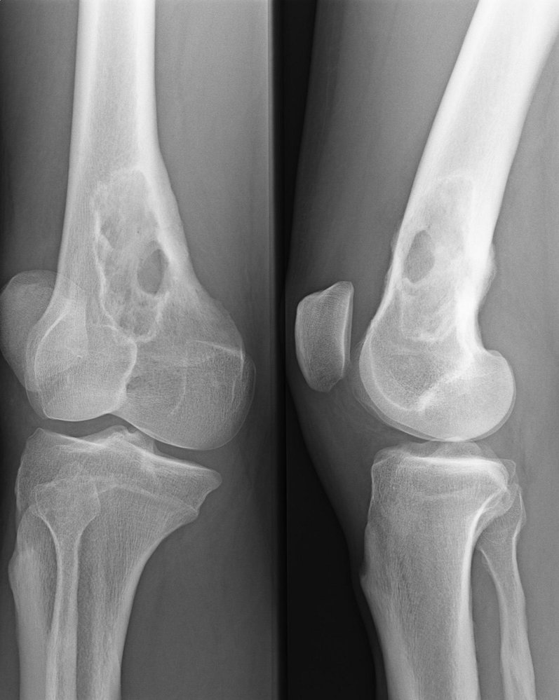 Plasmacytoma of the femur
