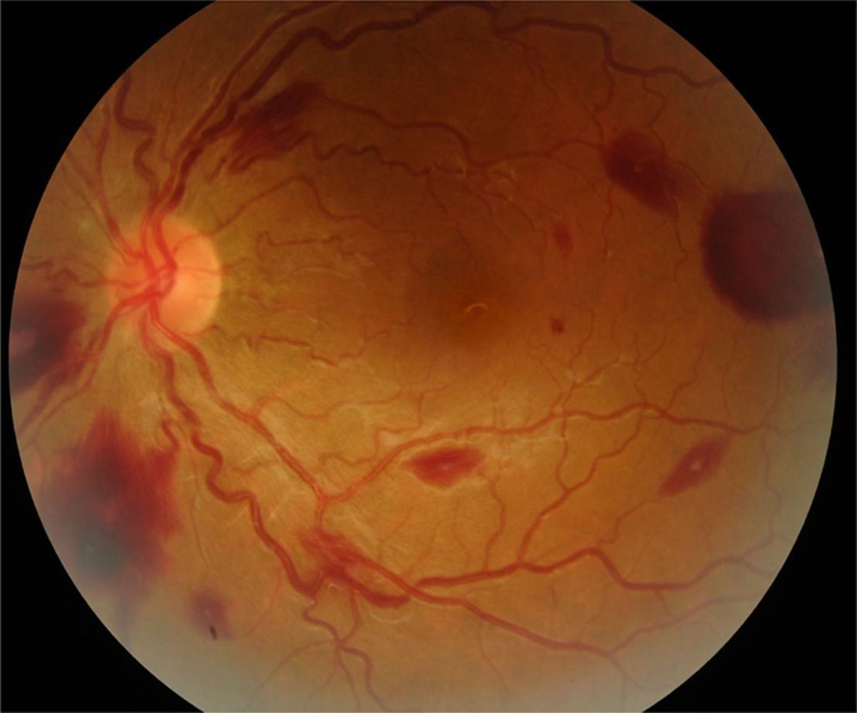 Roth spots