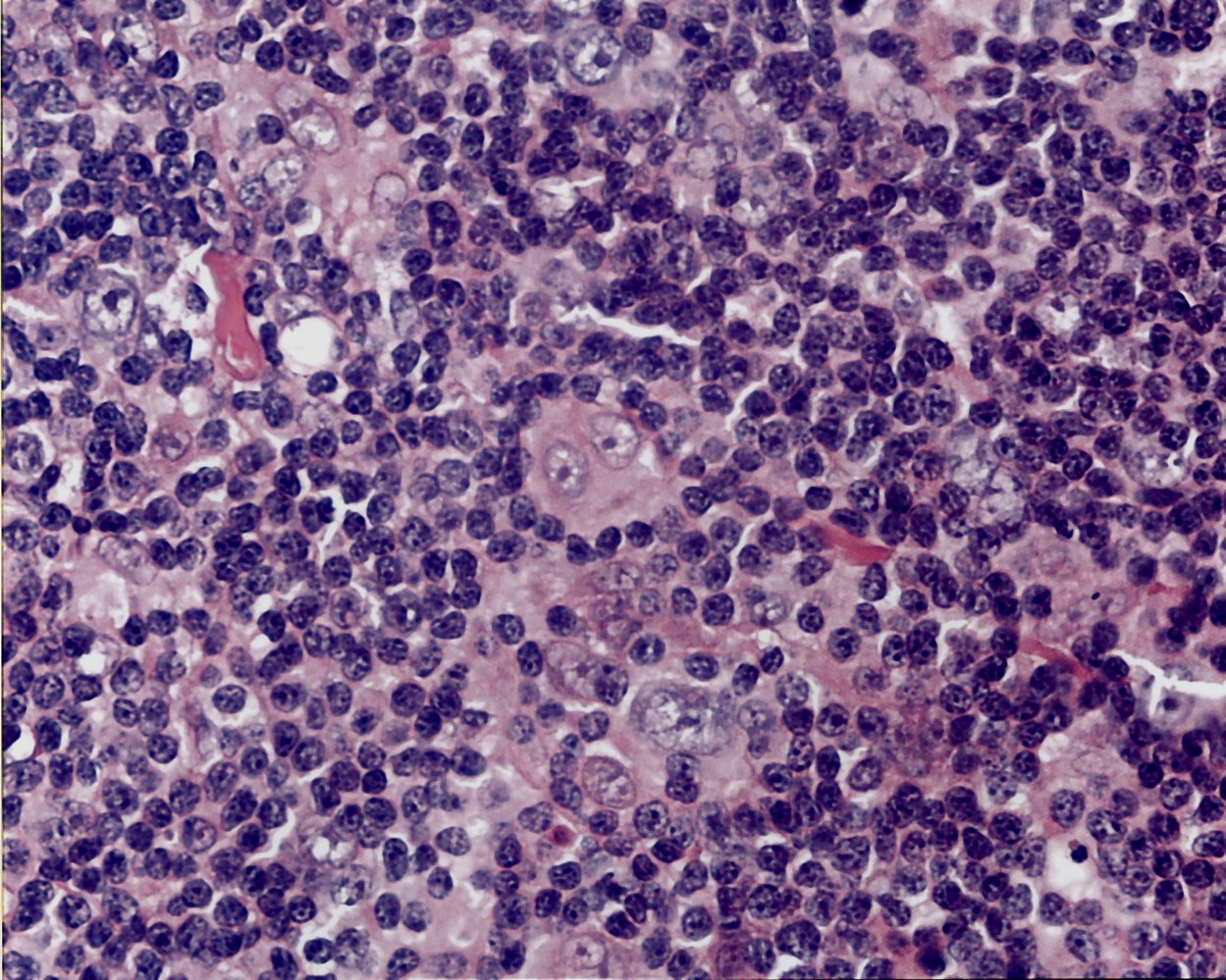 Hodgkin lymphoma