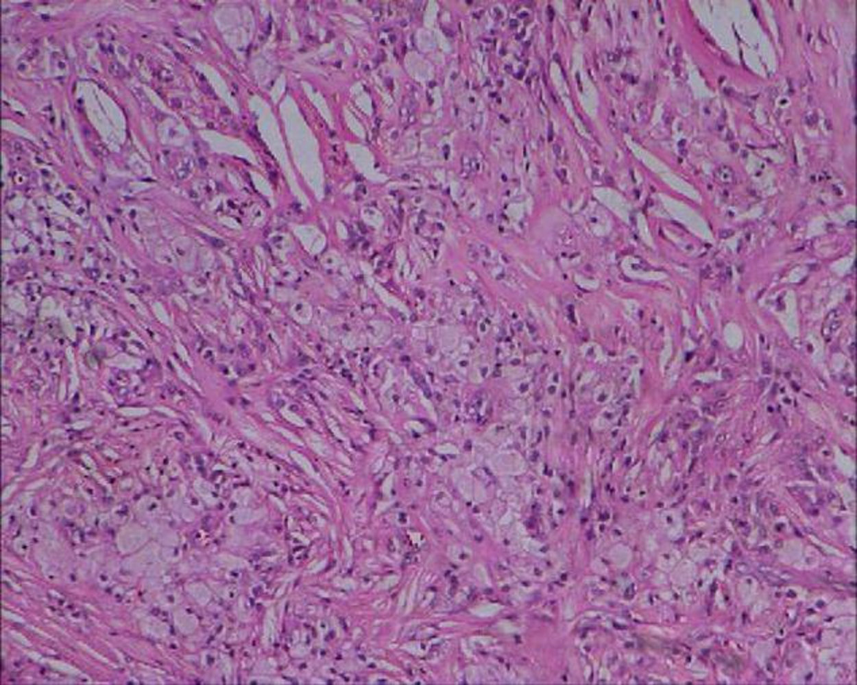 Xanthoma