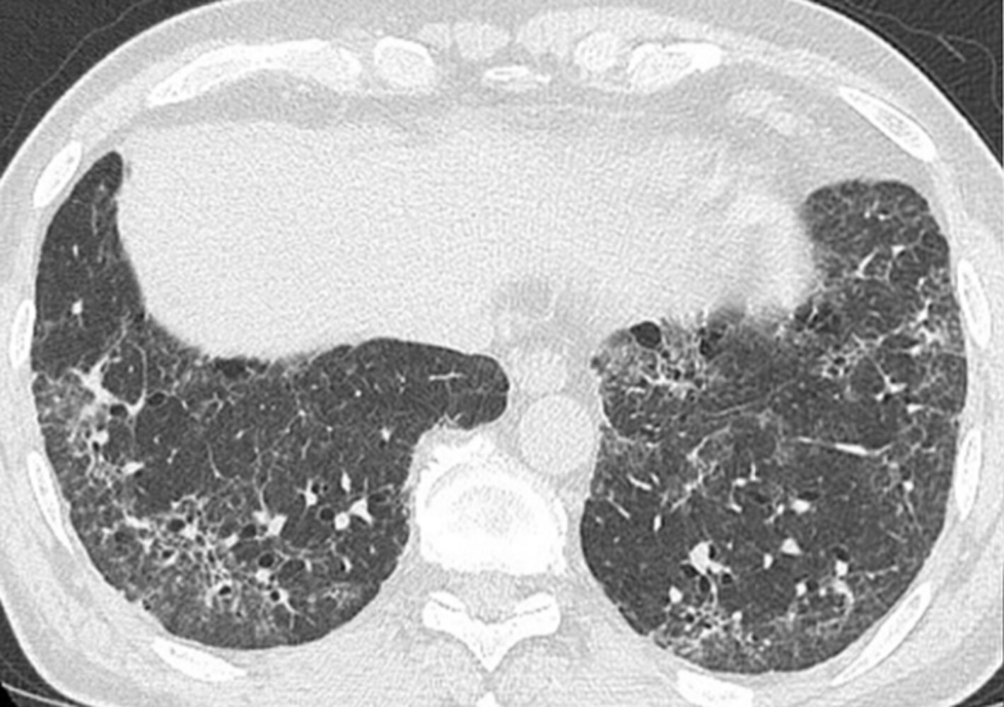 Nonspecific interstitial pneumonia (NSIP)