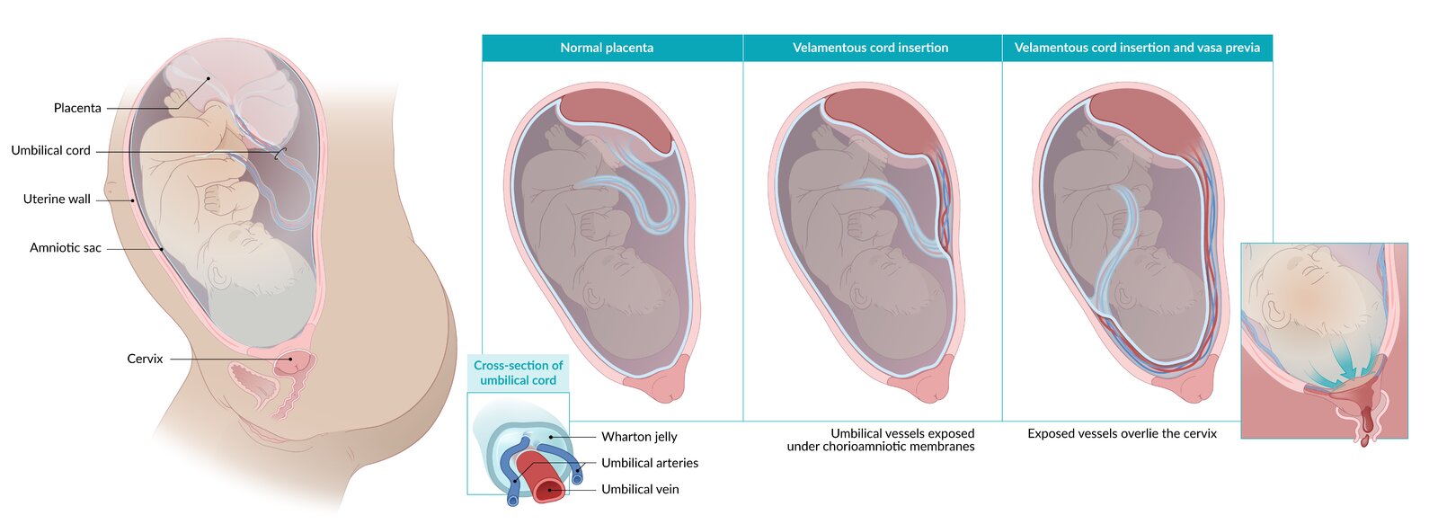 Velamentous cord insertion