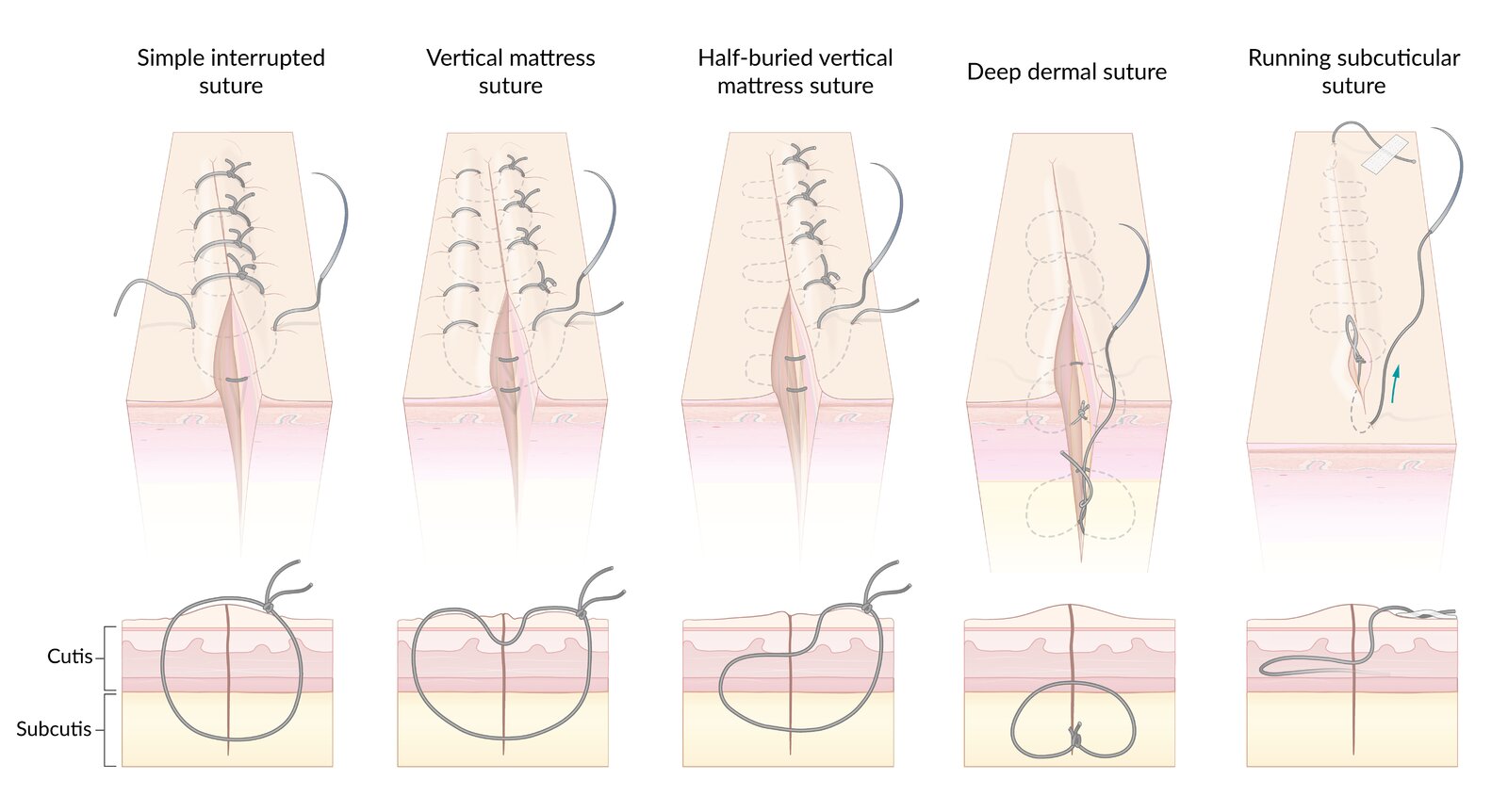 Suturing techniques