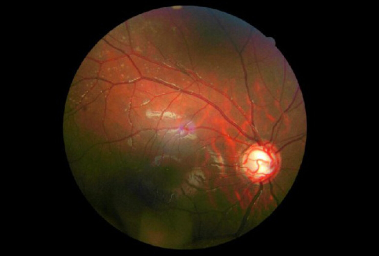 Cupping of the optic disc in advanced glaucoma