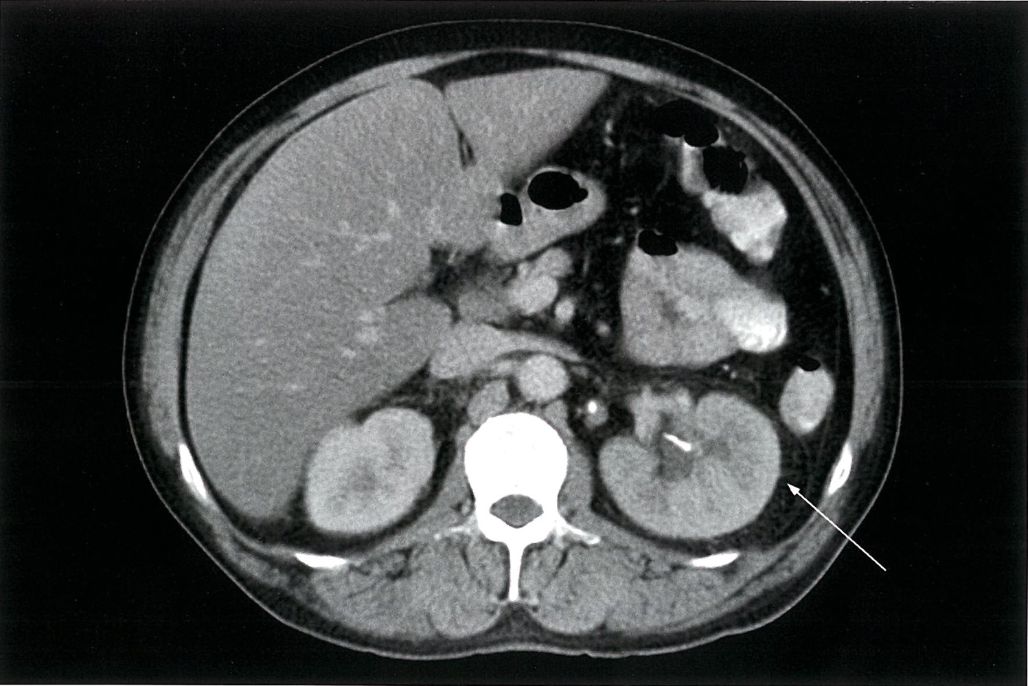 Acute pyelonephritis and renal calculi