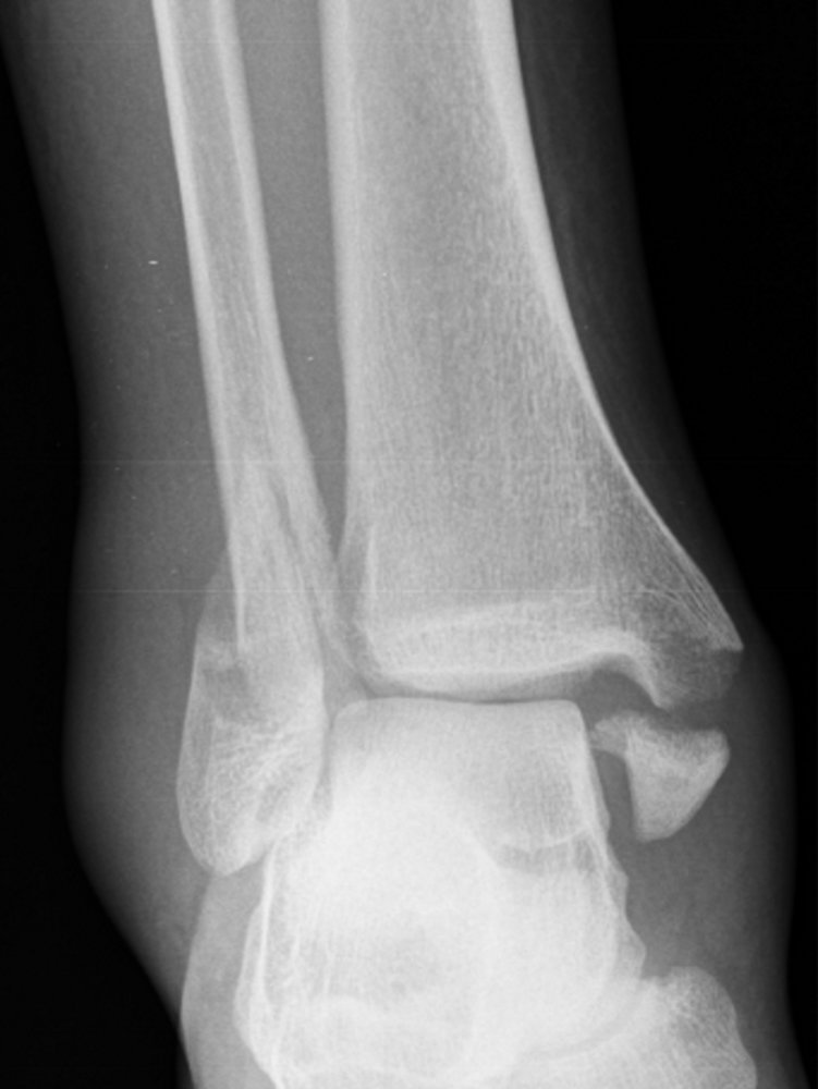 Trimalleolar ankle fracture