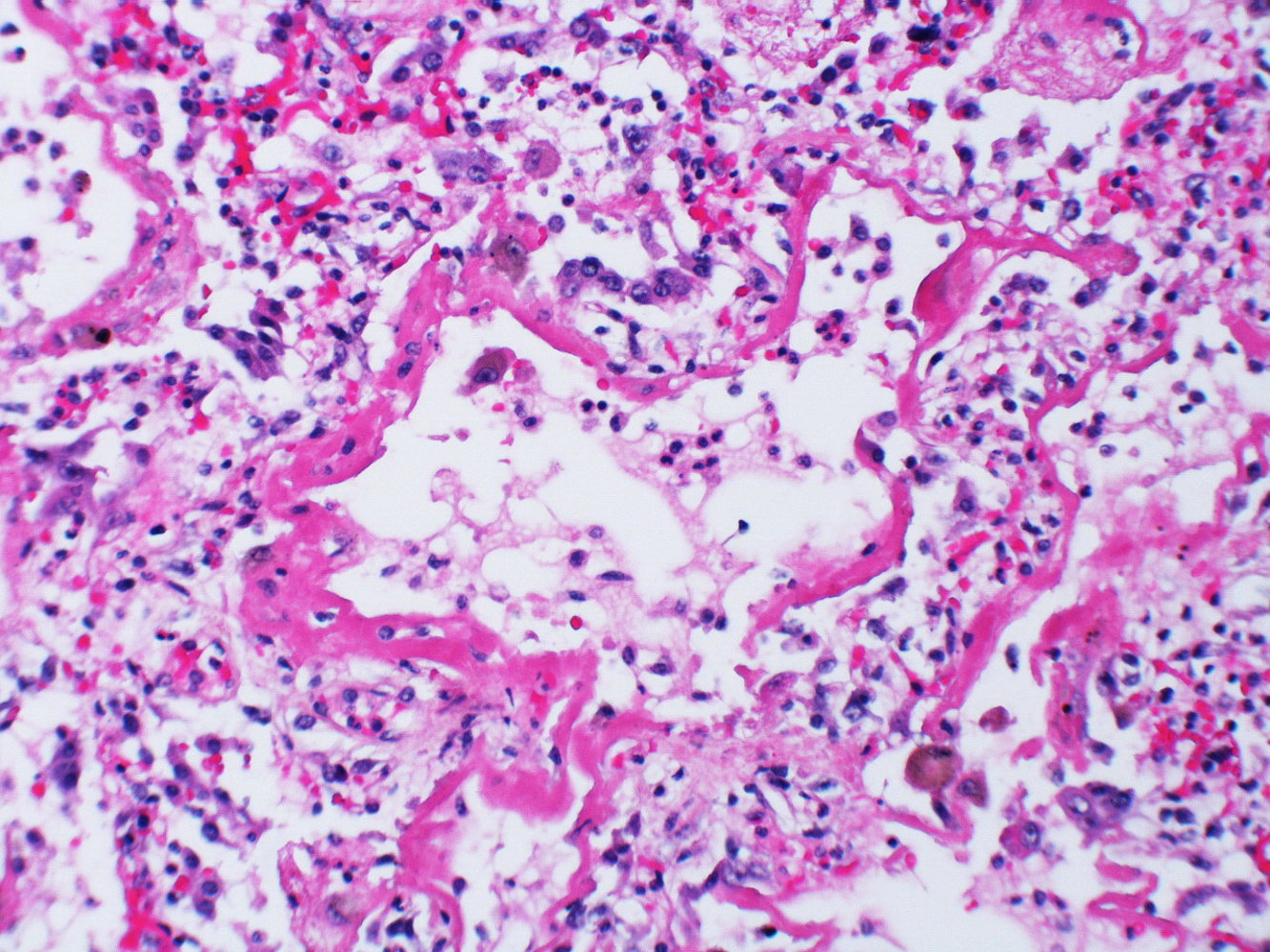 ARDS (acute exudative phase)