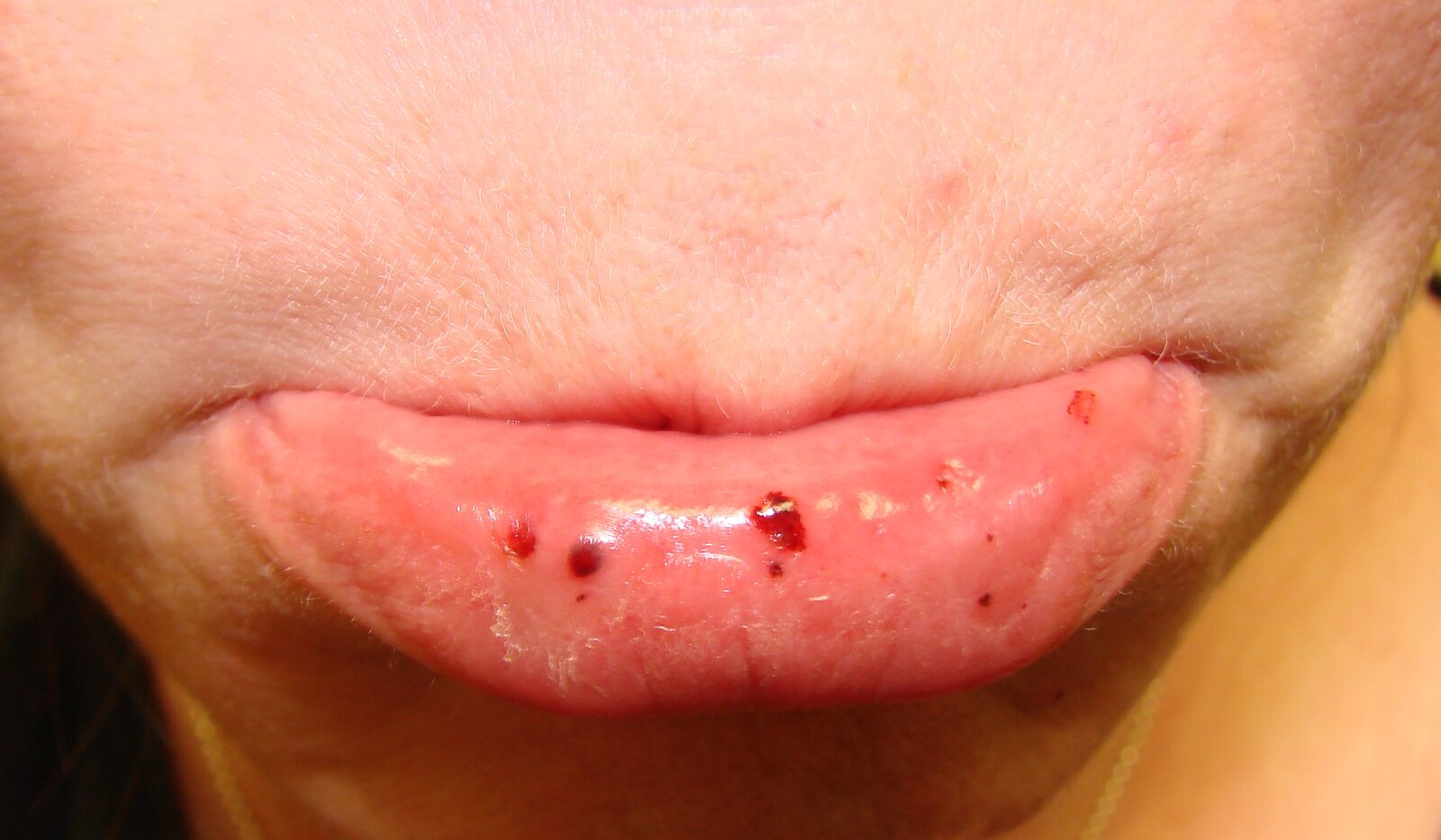 Oral petechiae in ITP