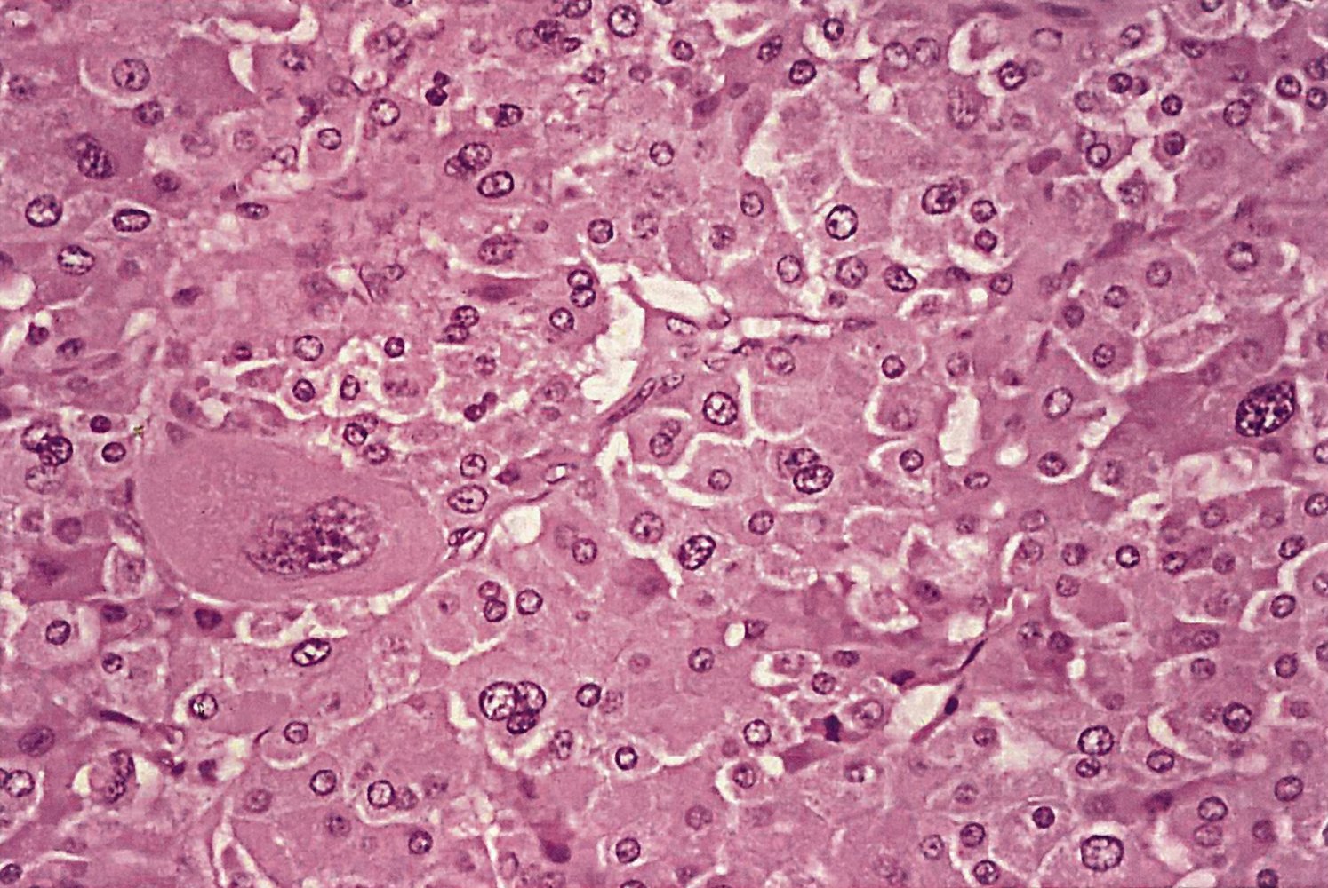Renal oncocytoma
