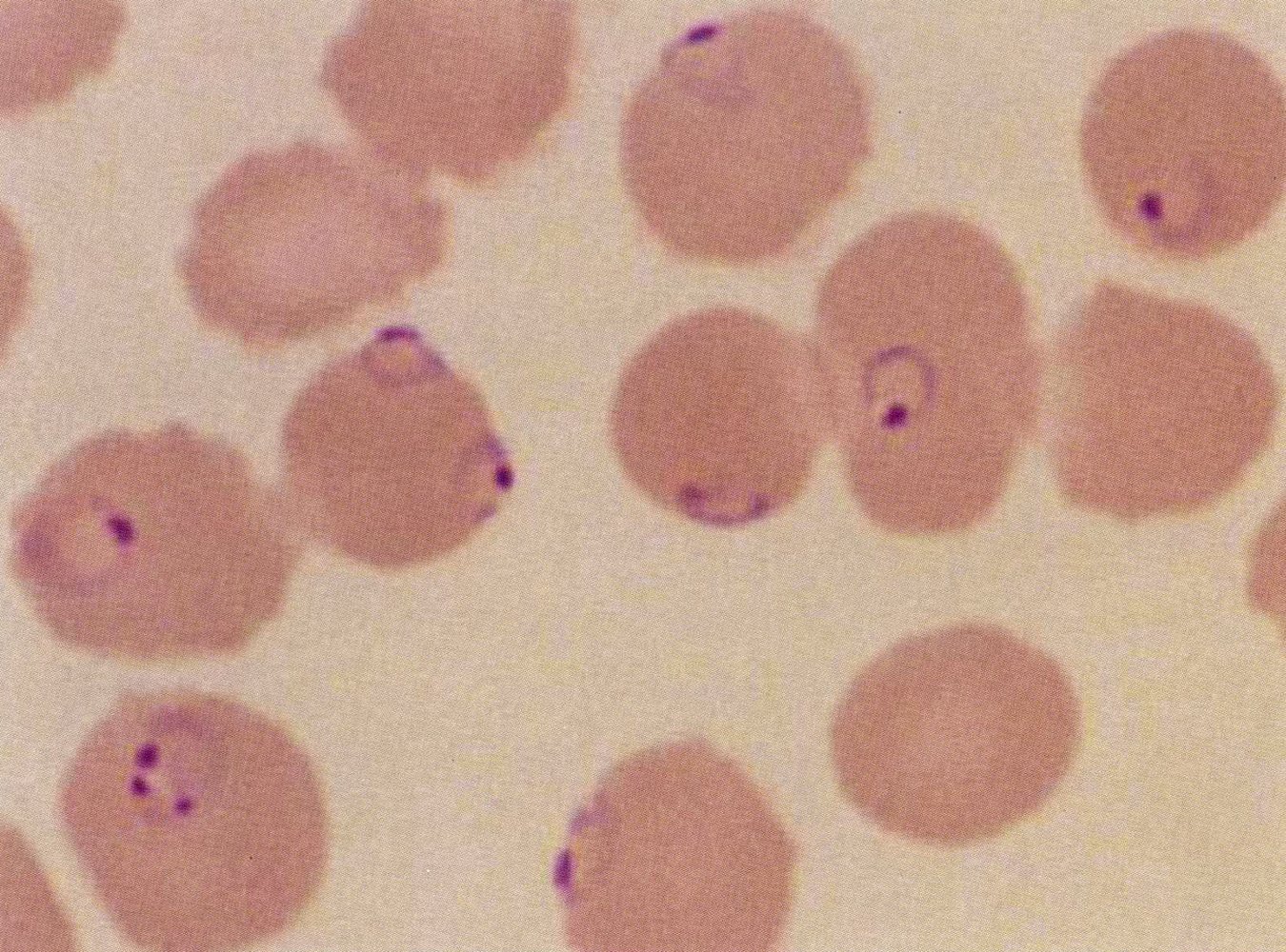 Falciparum malaria: immature trophozoite in Plasmodium falciparum infection