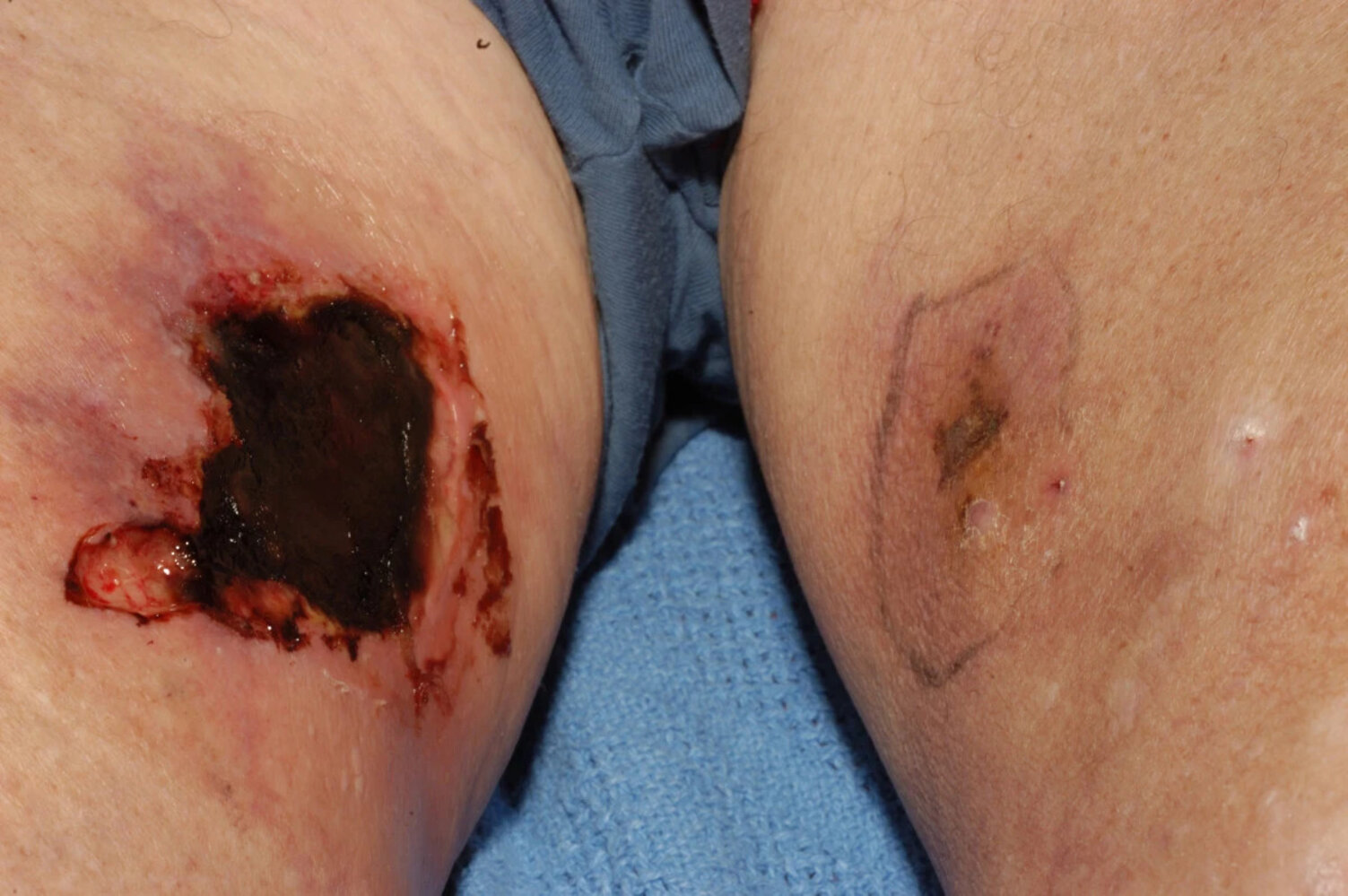 Calciphylaxis
