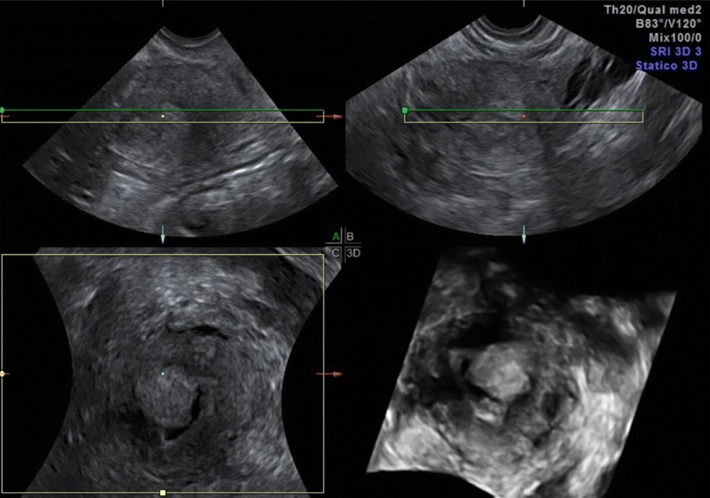 Endometrioid adenocarcinoma