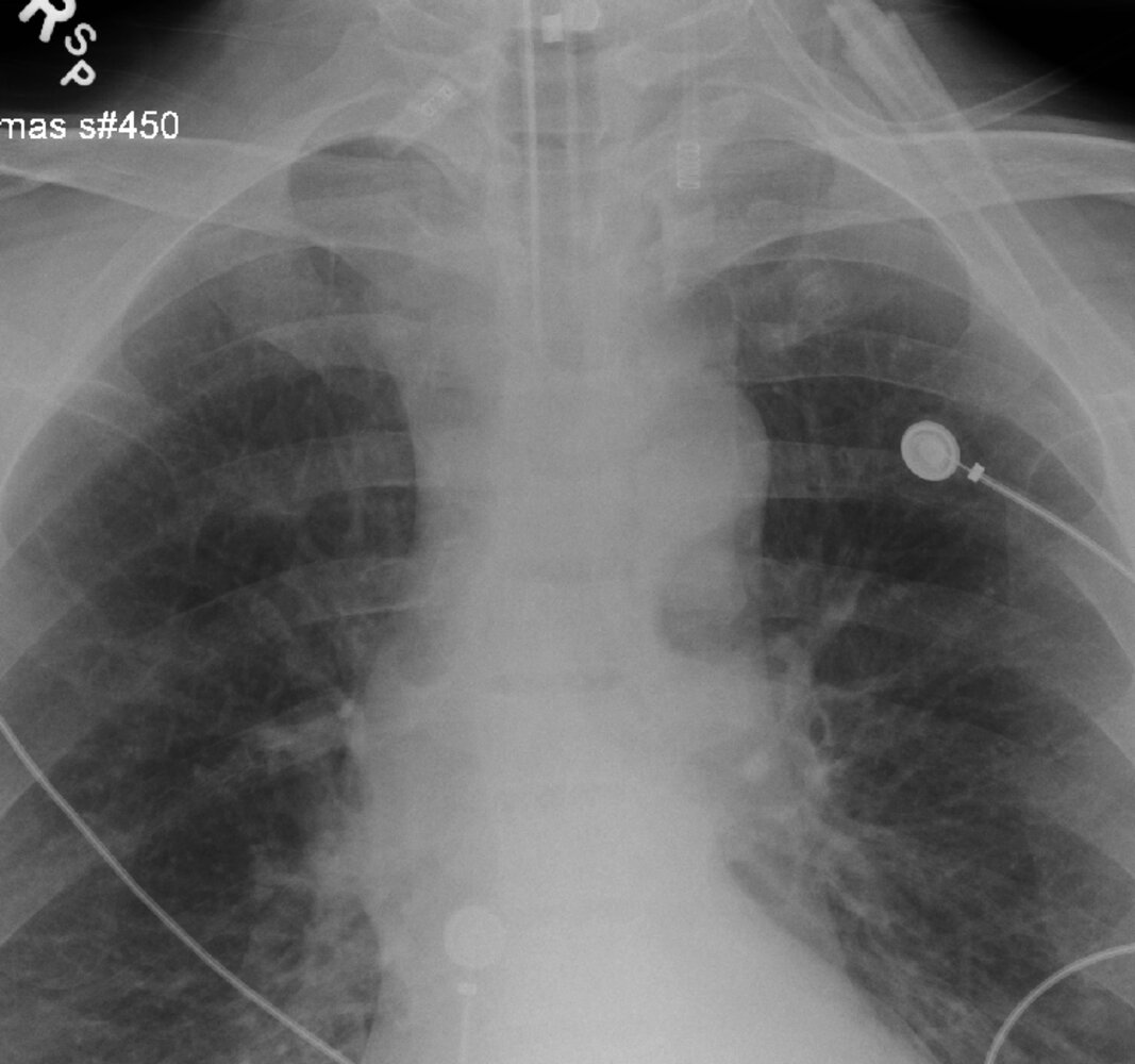 Well-positioned endotracheal tube