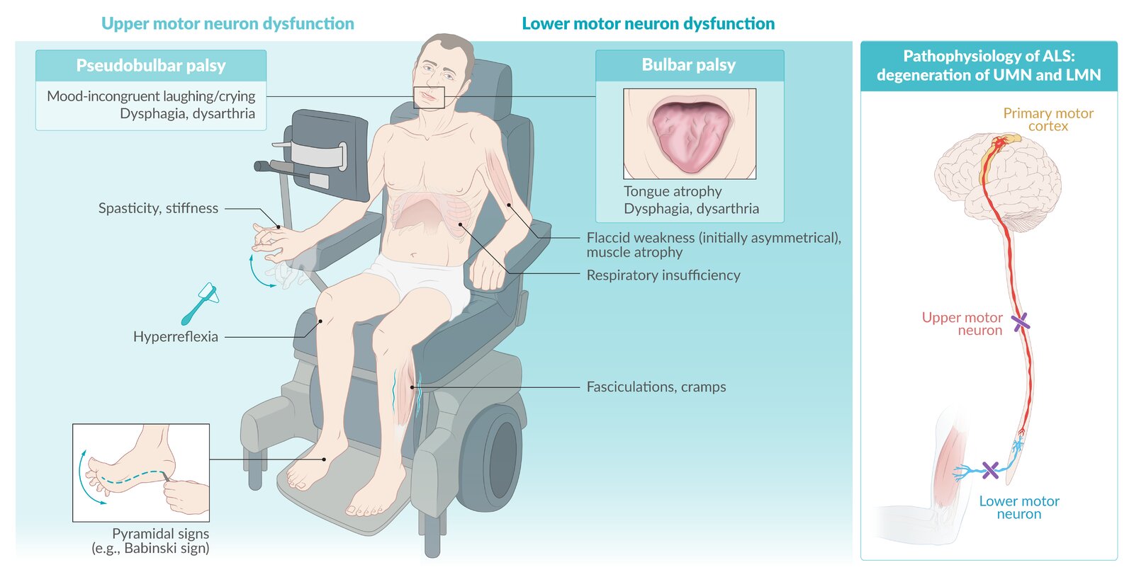 Clinical features and pathophysiology of amyotrophic lateral sclerosis