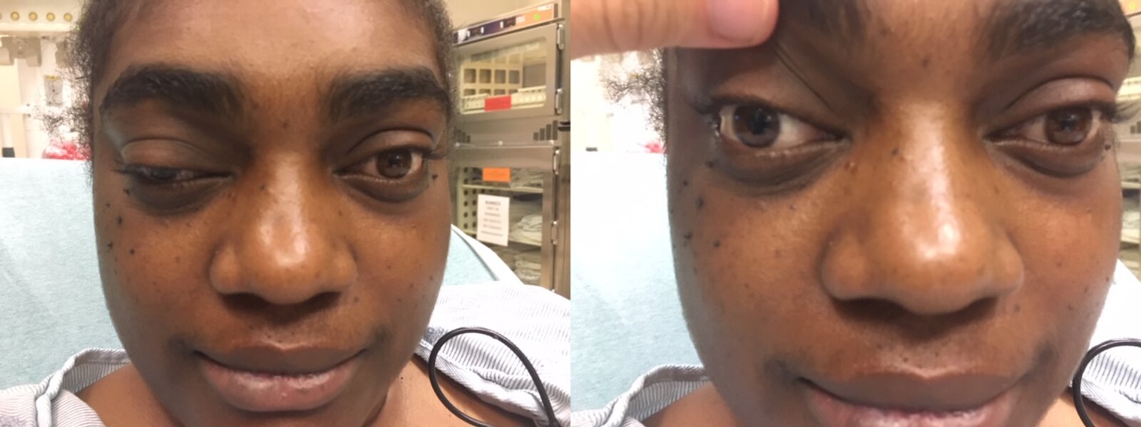Cranial nerve III palsy in artery aneurysm