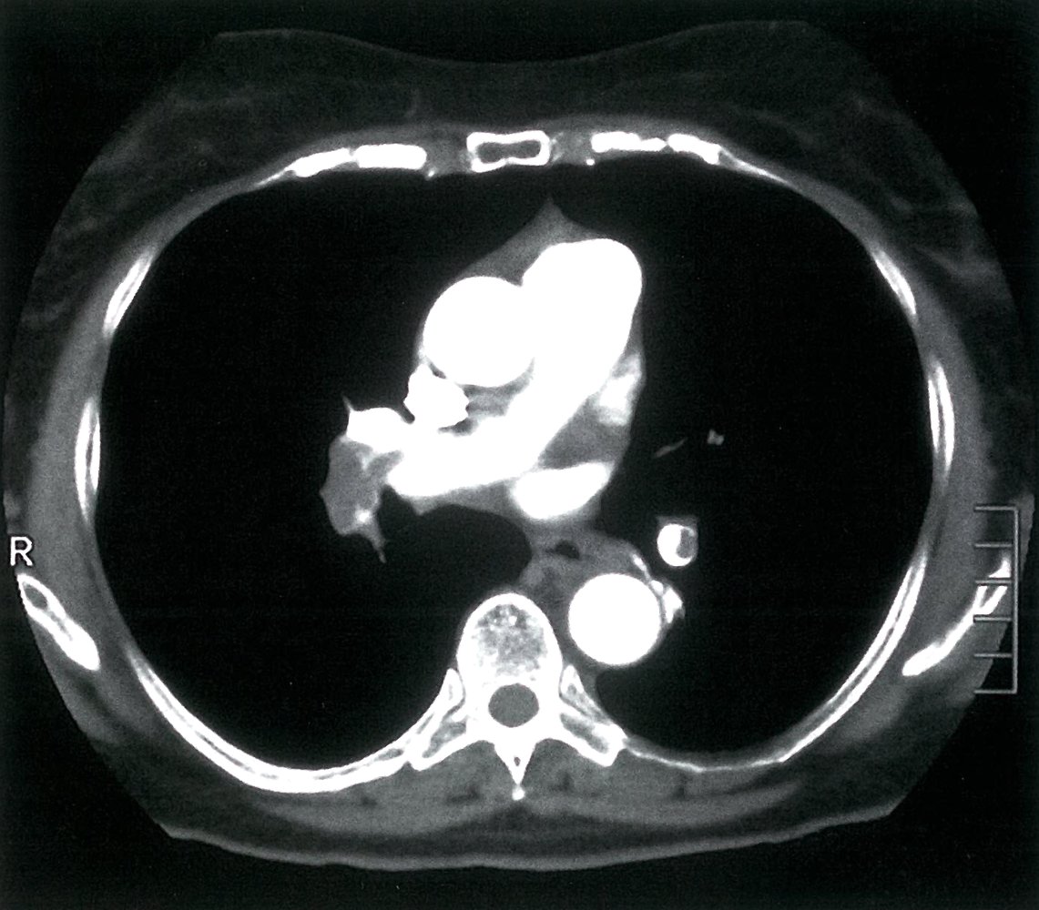 Pulmonary embolism