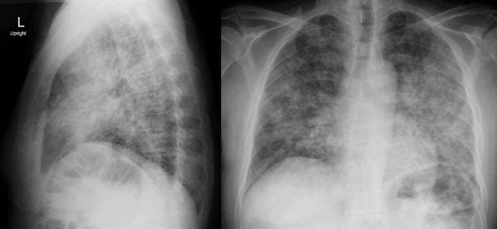 Pneumocystis jirovecii pneumonia (PCP)