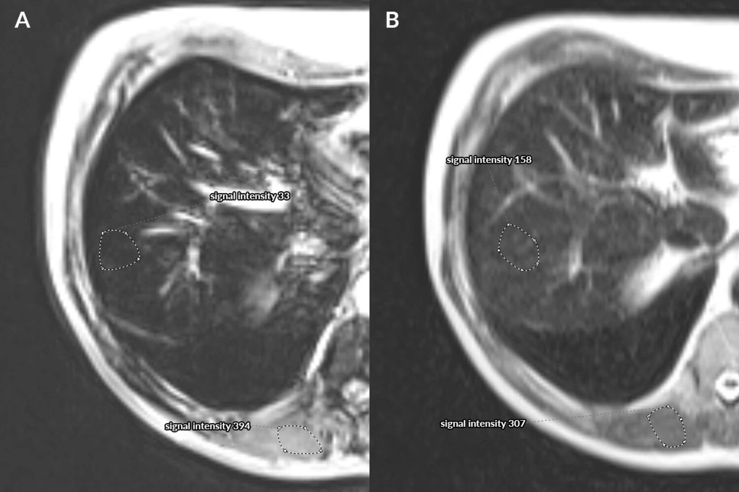 Hereditary hemochromatosis