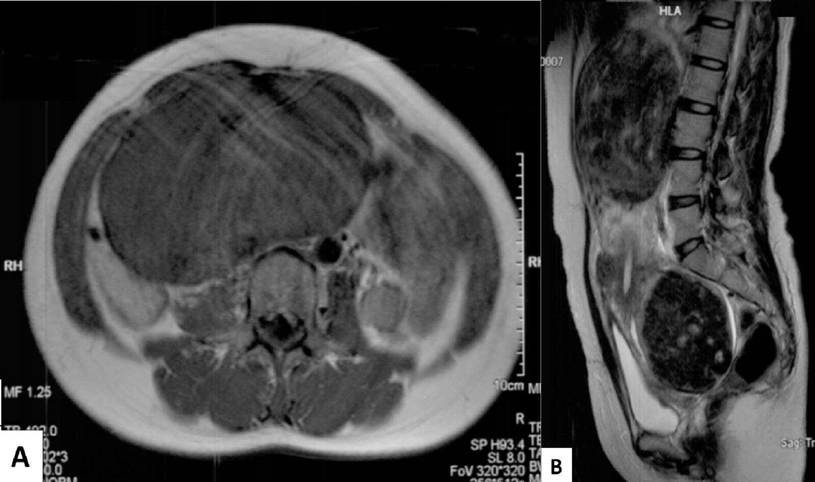 Uterine leiomyoma (fibroid)