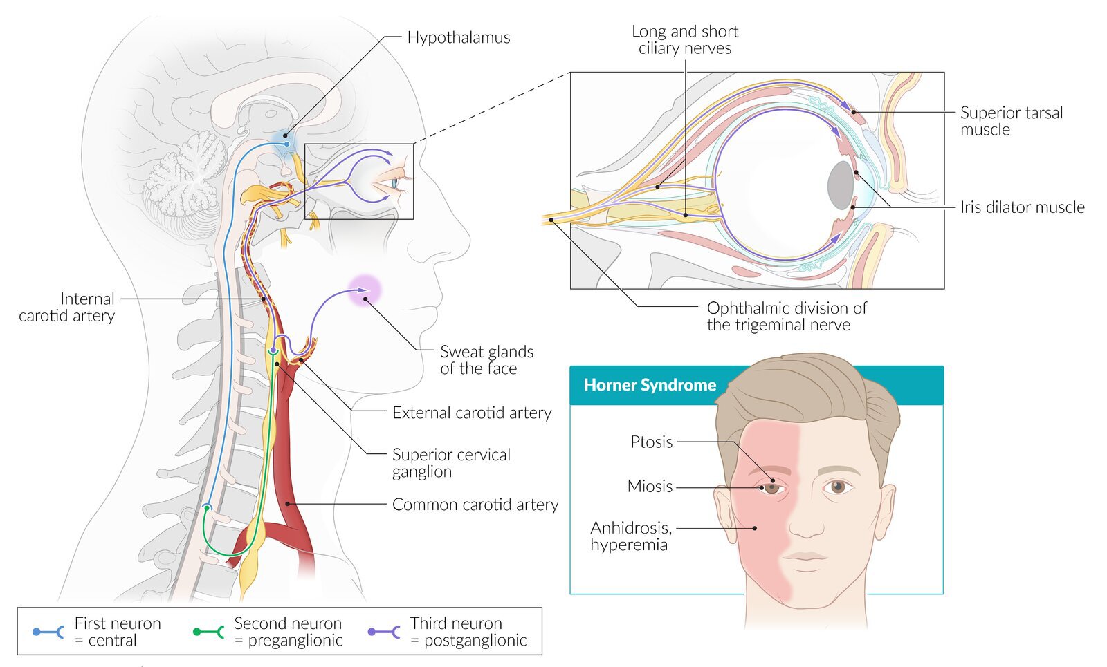 Horner syndrome