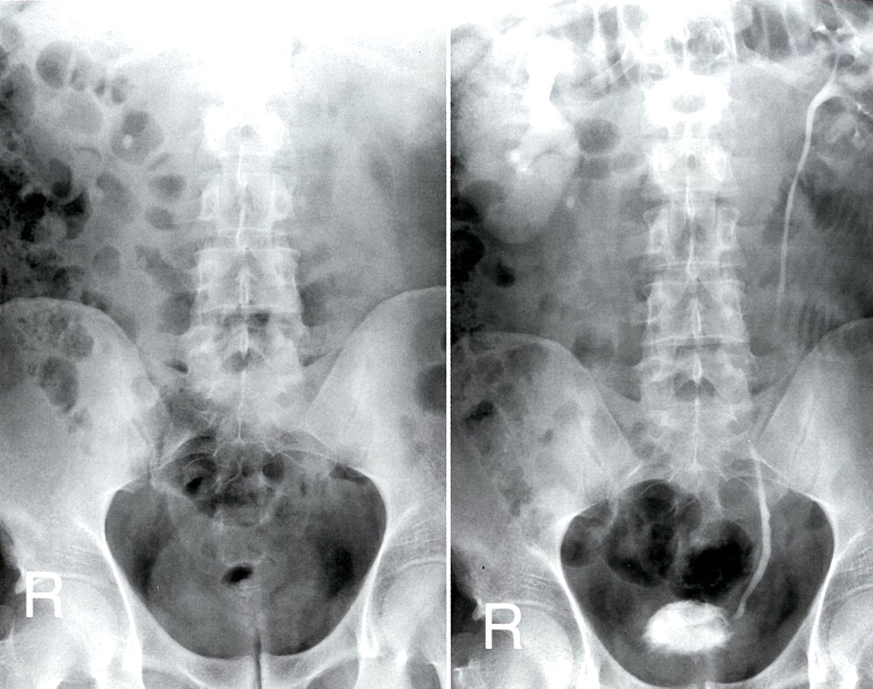 Obstructing ureteral calculus