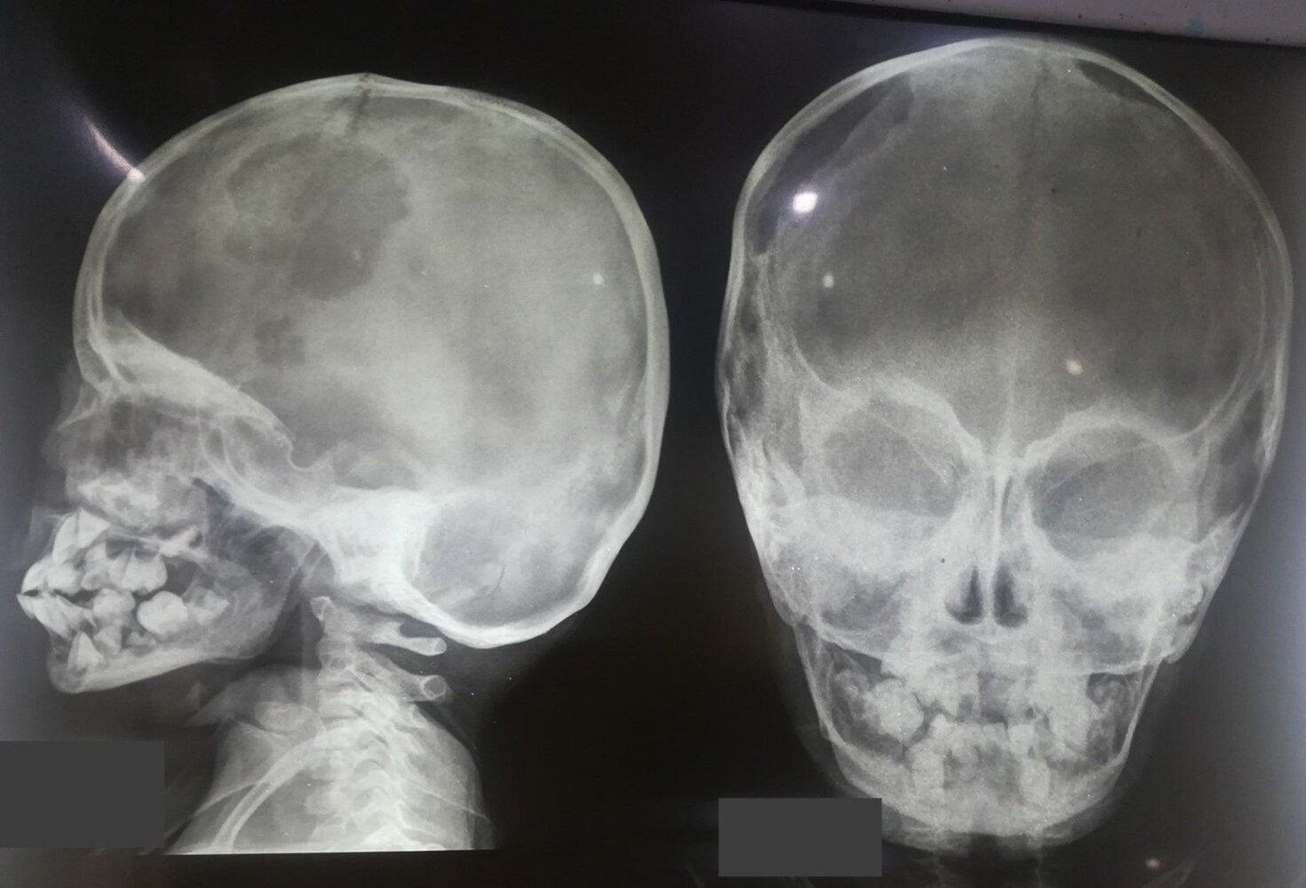 Lytic skull lesion