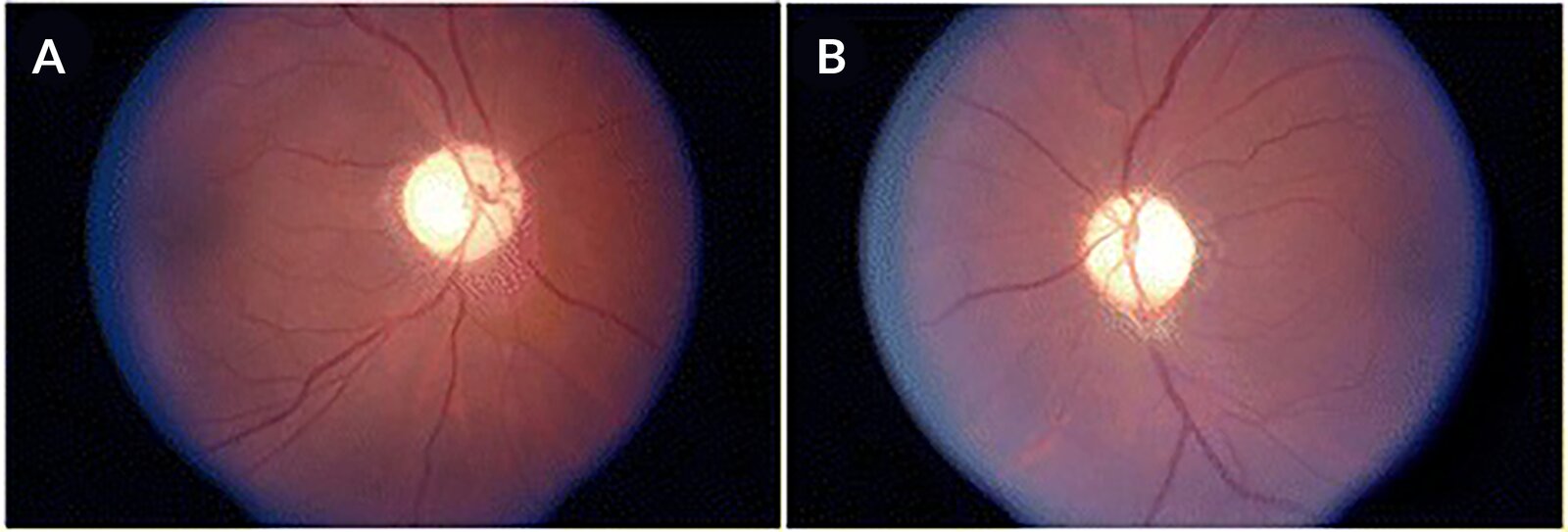 Optic atrophy