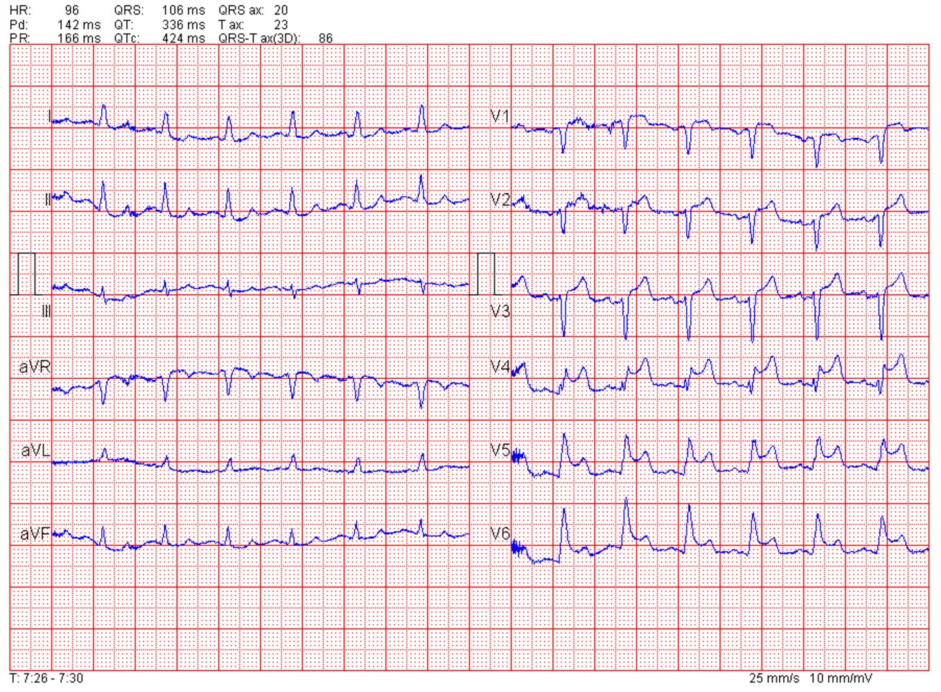 Acute anterior ST elevation myocardial infarction (STEMI)